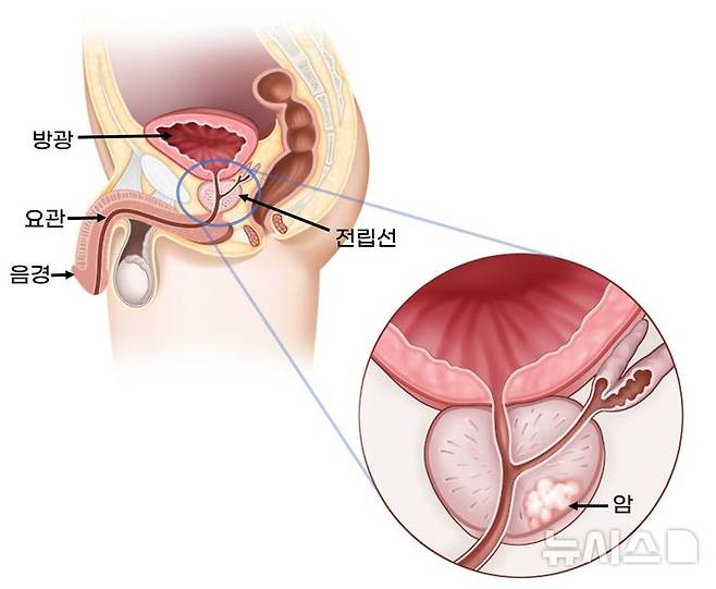 [서울=뉴시스]전립선암. (이미지= 서울아산병원 제공) 2025.05.20. photo@newsis.com.