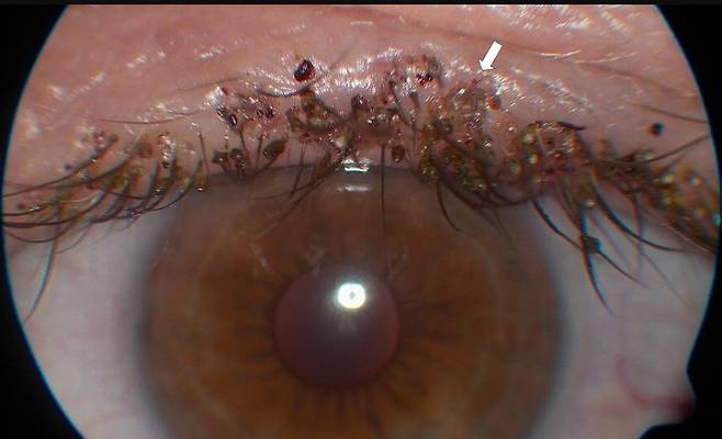 [뉴시스] 극심한 가려움증을 호소하던 50대 남성의 눈꺼풀에서 사면발이가 발견된 이례적인 사례가 보고됐다. (사진= 피부과 온라인 저널(Dermatology Online Journal) 캡처) *재판매 및 DB금지 *재판매 및 DB 금지