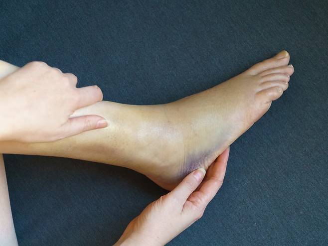 동상 관련 사진. 게티이미지뱅크