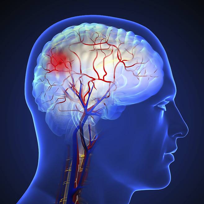 겨울철 뇌졸중 전조증상은 ‘F·A·S·T 법칙’으로 확인할 수 있다. 얼굴·팔·언어 이상이 나타나면 즉시 병원을 찾아야 한다. 클립아트코리아