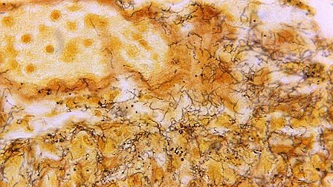 미국 질병통제예방센터(CDC)가 공개한 매독에 감염된 인체 조직의 현미경 사진