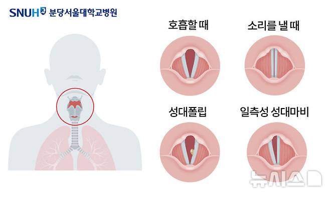 [서울=뉴시스]성대의 구조와 원리. (사진= 분당서울대병원 제공)