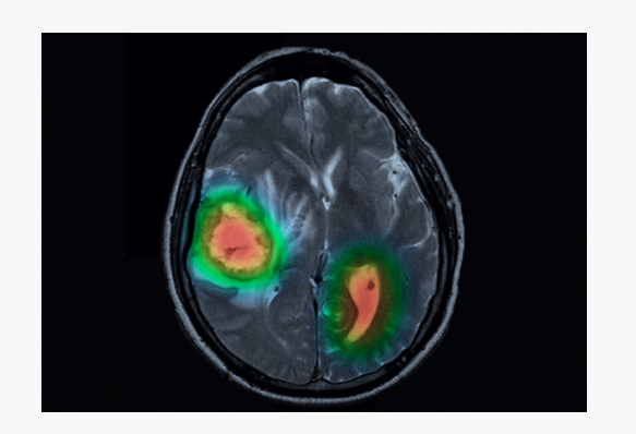 뉴로클의 비전검사 소프트웨어가 뇌 MRI에서 이상 소견을 찾아내는 모습.(사진=뉴로클)