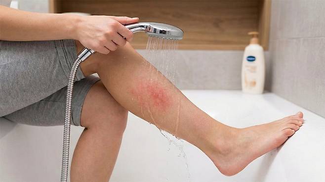 저온화상 발생 시 빨리 시원한 물로 열을 식히고, 피부과에서 손상의 깊이를 확인해야 한다｜출처: Gemini