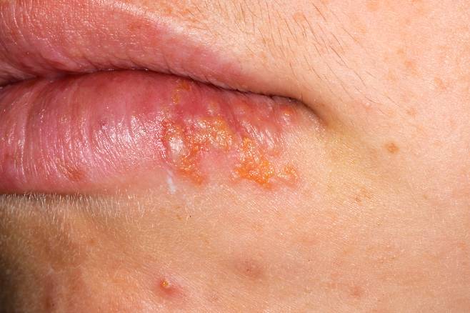 입술 물집은 재발이 잦다. 물집은 입술과 피부의 경계에서 가장 흔하며 코, 턱, 뺨, 입안 점막에도 생긴다. 사진=클립아트코리아