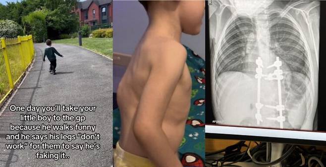 네 살 아들의 걸음걸이가 점점 이상해진다고 느낀 부모가 병원을 데려갔지만, 의사는 수개월간 아이의 증상을 '바이러스 감염, 절뚝 거리는 건 관심을 끌려는 연기, 꾀병'으로 판단하다 결국 '척추 결핵(spinal tuberculosis)'을 진단 받았다는 사연이 전해졌다. 사진=메건 SNS
