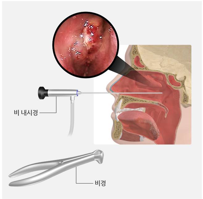 비강검사에서 비용종, 화농성 콧물, 점막 부종 또는 폐색은 부비동염의 전형적인 검사 소견이다. /자료=국가건강정보포털