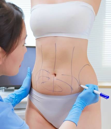 지방흡입(Liposuction) 수술에 앞서 '디자인 그림'을 그리고 있다. 미국의 저명한 성형외과 의사가 '점심시간 지방흡입' 수술의 위험성을 경고하고 나섰다. 사진=게티이미지뱅크