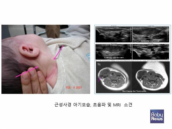 근성사경 아기모습, 초음파 및 MRI 소견. ⓒ임신영