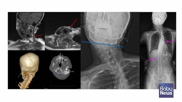 좌측 근성사경으로 인한 측경, 척추측만증 및 두개골 변형. ⓒ임신영