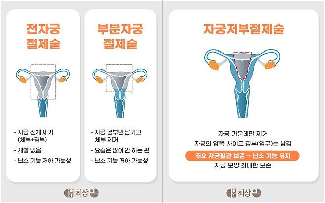 자궁저부절제술은 병변 제거와 기능 보존에 특화된 수술법이다｜출처: 최상산부인과