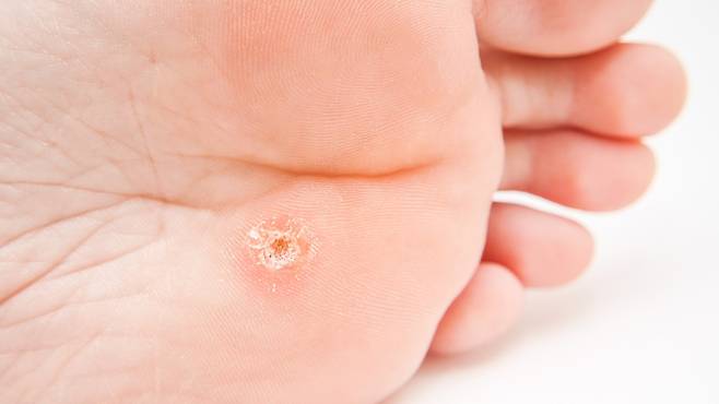 족저사마귀는 인유두종바이러스(HPV)에 의한 감염으로 방치 시 다른 부위로 확산될 수 있다｜출처: 게티이미지뱅크