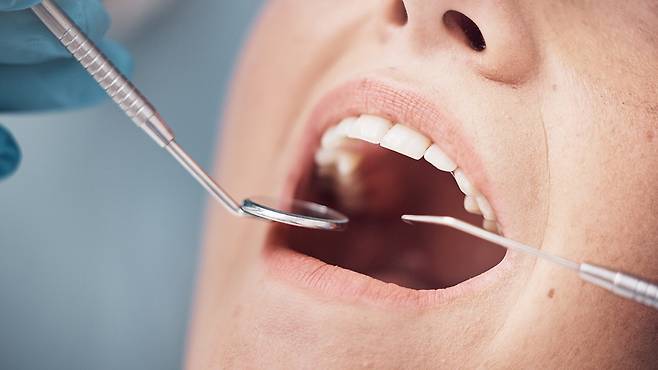 치과 치료의 기본 원칙은 가능한 한 자연치아를 보존하는 데 있다｜출처: 게티이미지뱅크