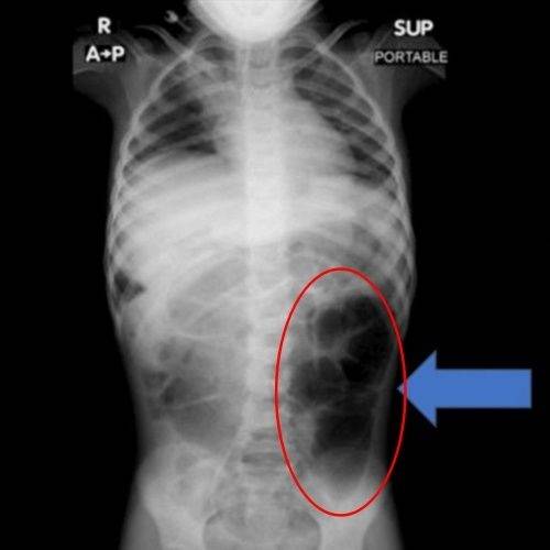 위와 소장이 머리카락으로 막혀 있는 모습. 사진=큐레우스
