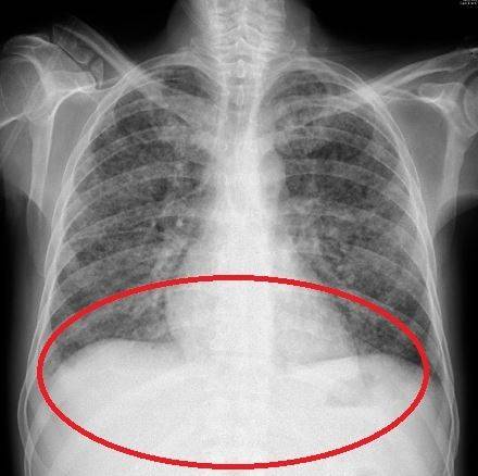알코올 중독이었던 40대 남성이 기생충 감염 후 사망한 사례가 보고됐다. 염증이 난 남성의 엑스레이 사진./사진=콜롬비아 국립보건연구소 학술지