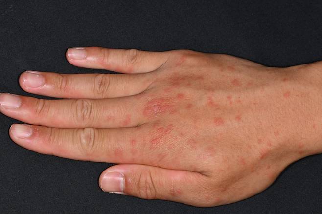 한랭 두드러기는 피부가 차가운 공기나 물 등 저온 자극에 노출되면서 발생하는 질환이다./사진=클립아트코리아