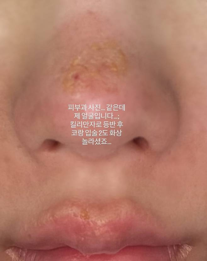 권은비가 코와 입에 2도 화상을 입었다. 권은비 SNS