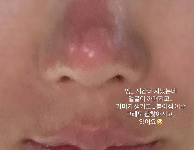 권은비가 코와 입에 2도 화상을 입고 난 뒤 경과. 권은비 SNS