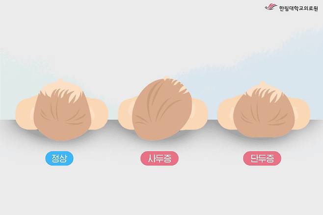 영유아의 두개골 변형 유형. 자료 한림대동탄성심병원
