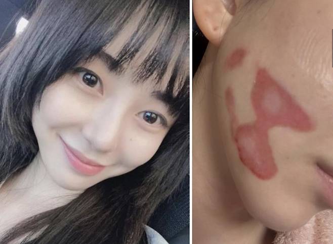 그룹 AOA 출신 권민아가 피부 시술로 심재성 2도 화상을 입었다며 공개한 사진. 왼쪽은 화상 이전 모습. 인스타그램 캡처
