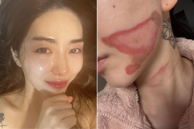 그룹 AOA 출신 권민아가 피부 리프팅 시술을 받았다가 화상 피해(오른쪽)를 입었다고 호소했다. 권민아 인스타그램 캡처