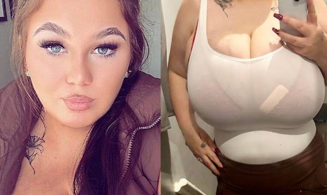 영국 20대 여성이 거대유방증 때문에 피부가 찢어지면서 패혈증까지 겪었다고 호소했다. 사진=데일리메일