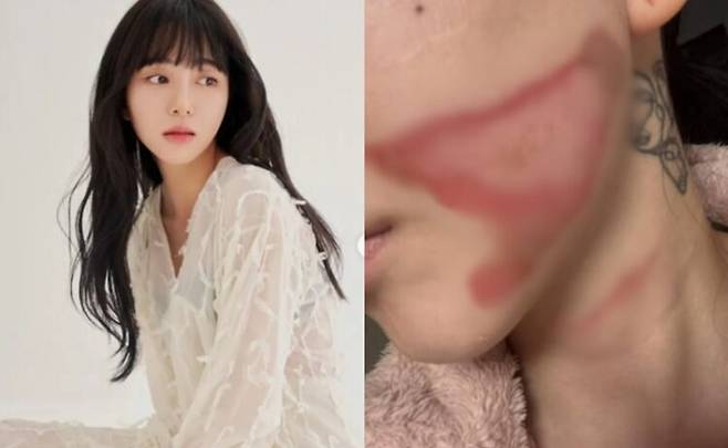AOA 출신 권민아가 슈링크 부작용으로 화상을 입었다며 사진을 공개했다. 사진=권민아 SNS