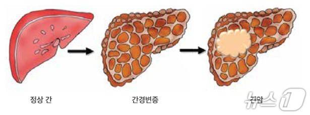 간암 진행 과정(대한간암학회·서울대병원 제공)