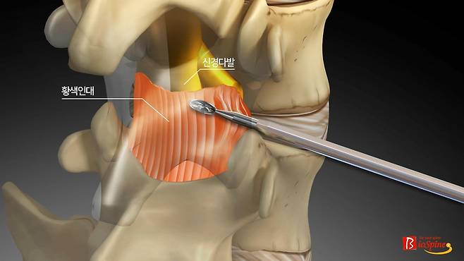 추간공 후방부의 황색인대를 특수 키트로 절제해 공간을 넓히는 추간공확장술 모습. 서울 광혜병원