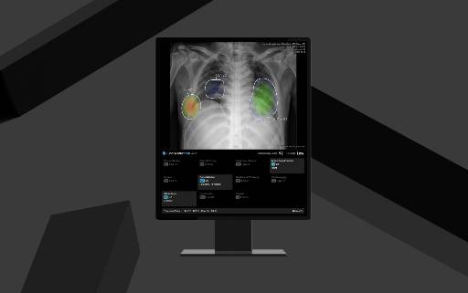 루닛의 흉부 엑스레이 AI 영상분석 솔루션 '루닛 인사이트 CXR4'. /사진제공=루닛
