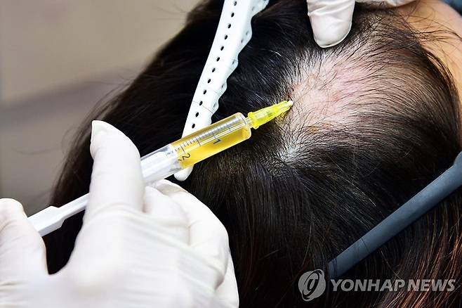 탈모 치료. 본문과는 직접적인 관계가 없는 사진. [연합뉴스]