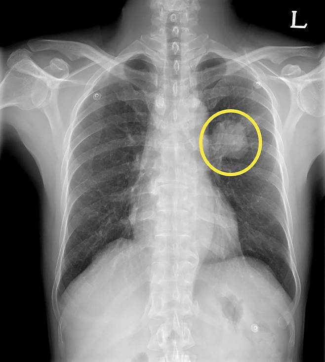 폐암 환자의 엑스레이 검사 사진