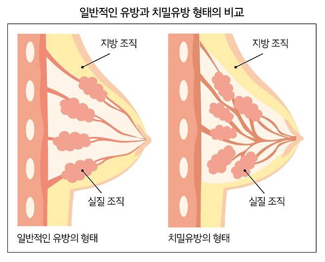 일반 유방과 치밀 유방 비교
