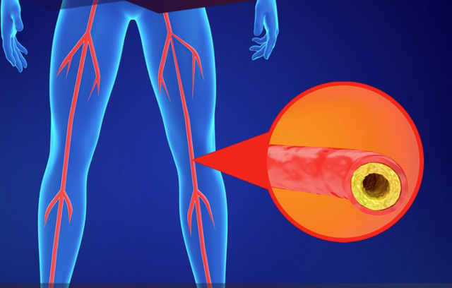 하지동맥폐색증 환자 중 60~70대 노년층에선 마른 환자가 대부분이며 흡연율과 관련도가 상당히 높다고 전문가들은 전한다. 강북삼성병원