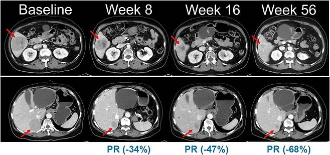 NRAS 돌연변이 흑색종 환자를 대상으로 진행된 벨바라페닙과 코비메티닙 병용요법 임상시험에서 시간 경과에 따른 병변 변화가 관찰된 복부 CT 영상. [한미약품 제공]