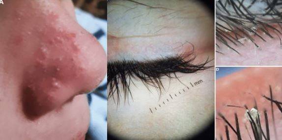 얼굴에 여드름처럼 보였던 피부 병변에서 모낭충이 발견된 사례가 보고됐다./사진=큐레우스