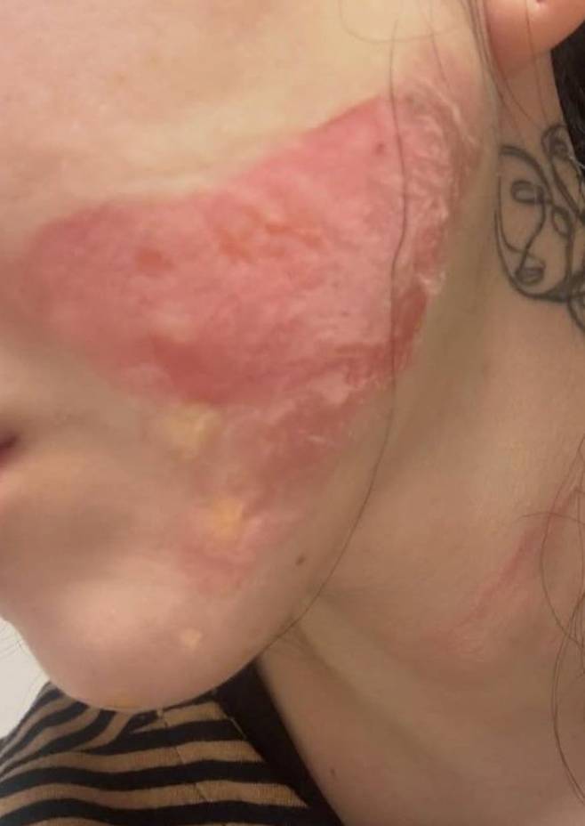 권민아가 23일 자신의 SNS에 올린 상처 사진./권민아 인스타그램 캡처