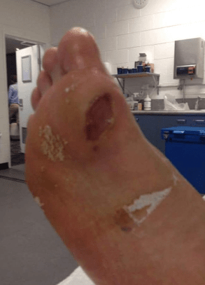 2018 호주오픈에서 물집이 잡힌 정현의 발바닥.