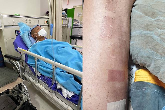 병원에서 치료를 받고 있는 이명식씨의 모습과 노스판 패치로 인해 화상을 입은 양쪽 허벅지./사진=이명식씨 제공