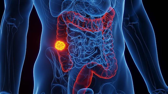 대장암은 관심을 가지고 관리하면 충분히 예방할 수 있는 질환이다|출처: 클립아트코리아