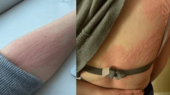 극심한 피부 가려움증을 호소한 20대 여성이 ‘피부묘기증’을 진단받은 사례가 보고됐다./사진=큐레우스