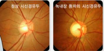 /자료=국가건강정보포털