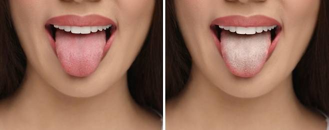혀 클리너 사용 전(왼쪽)과 후(오른쪽). 설태 제거만으로도 구강 환경이 눈에 띄게 달라진다. 123rf