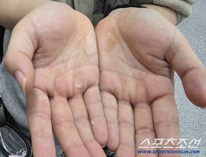 지난해 11월 전국장애인동계체전 수영 경기 후 만난 김윤지의 손바닥은 물집투성이였다. 이 엄청난 노력이 4개월 후 밀라노-코르티나 동계패럴림픽 현장에서 연속 메달의 기적으로 이어졌다. 사진=전영지 기자