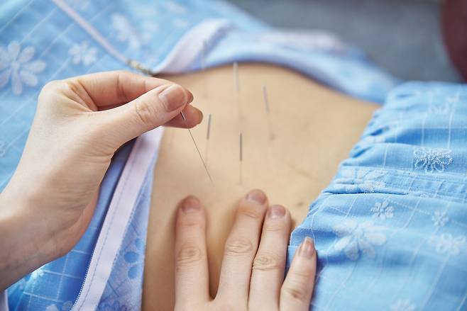 침술 자료 사진. 해당 사진은 기사 본문과 관계 없습니다. [게티이미지뱅크]