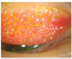 알레르기 결막염 일종인 봄철각결막염에서 나타난 거대유두. 윗눈꺼풀판결막에 마치 자갈을 깔아 놓은 것 같은 병변을 형성한다. /사진=국가건강정보포털