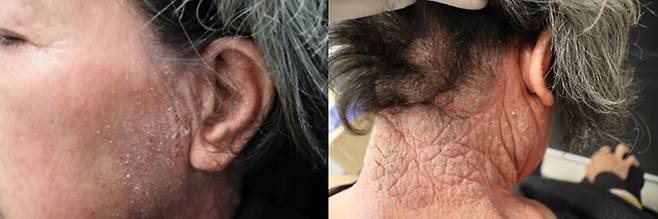 지루피부염 자료 사진./사진=중앙대학교광명병원 제공