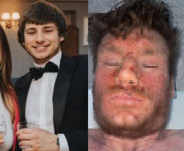 영국 20대 남성이 스테로이드 연고를 장기간 사용하다 갑자기 중단하며 심각한 피부 반응을 겪은 안타까운 사연이 전해졌다./사진=더 선