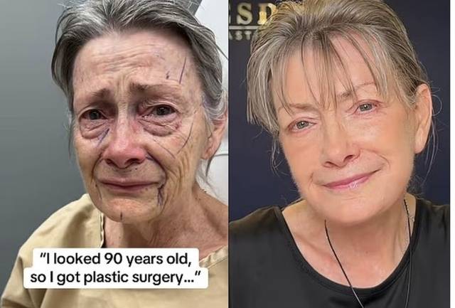 안면거상 수술을 받은 70세 여성의 수술 전(왼쪽)과 수술 후(오른쪽) 모습. 틱톡 뉴시스