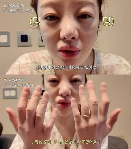 42세 황보라, 시험관 주사 부작용으로 얼굴 '퉁퉁'..각막까지 손상 "만신창이"